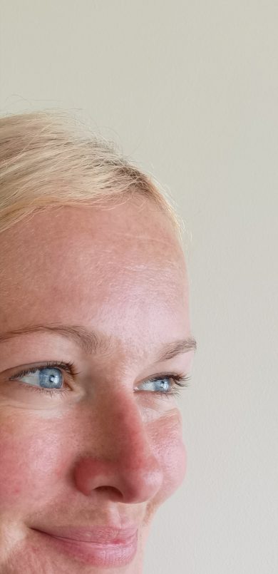 Close up of forehead after anti wrinkle injection