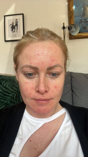 Image of Lorna Weightman demonstrating rosacea skin issue before treatment 